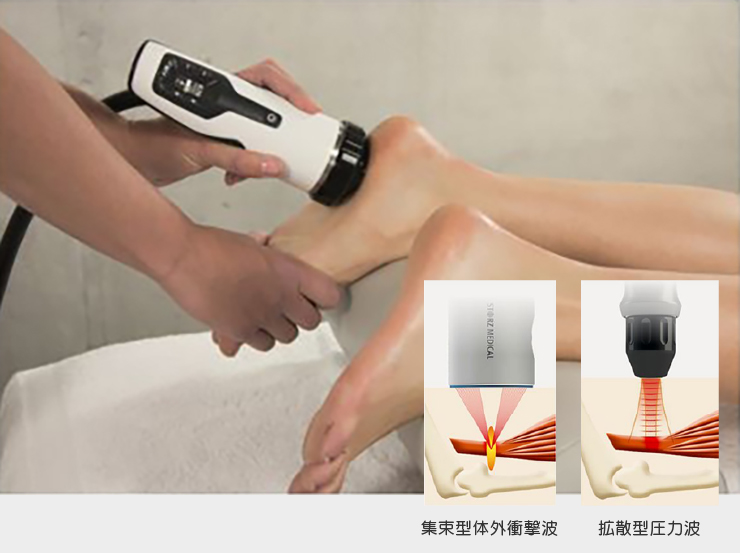 体外衝撃波治療